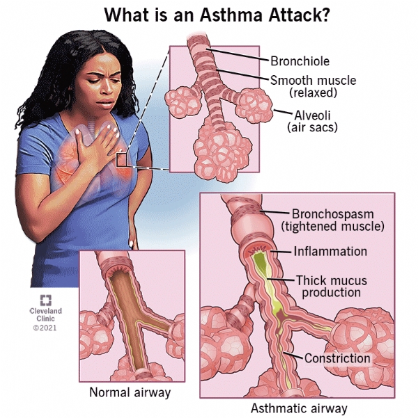 Hội chứng ngừng thở khi ngủ - mối nguy hại với bệnh nhân bệnh phổi tắc nghẽn mạn tính