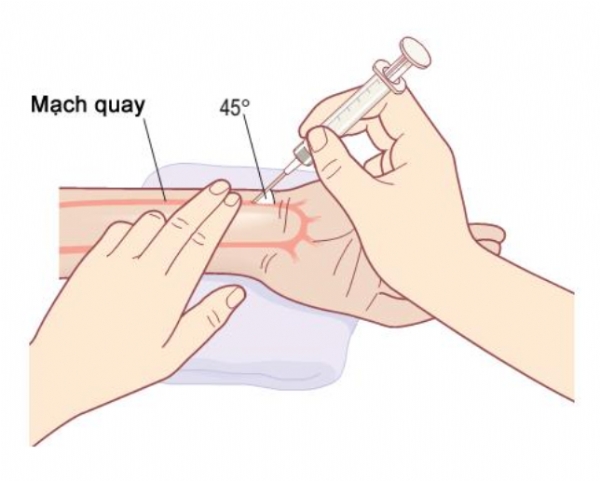 Đo khả năng khuếch tán khí qua màng phế nang mao mạch (DLCO)